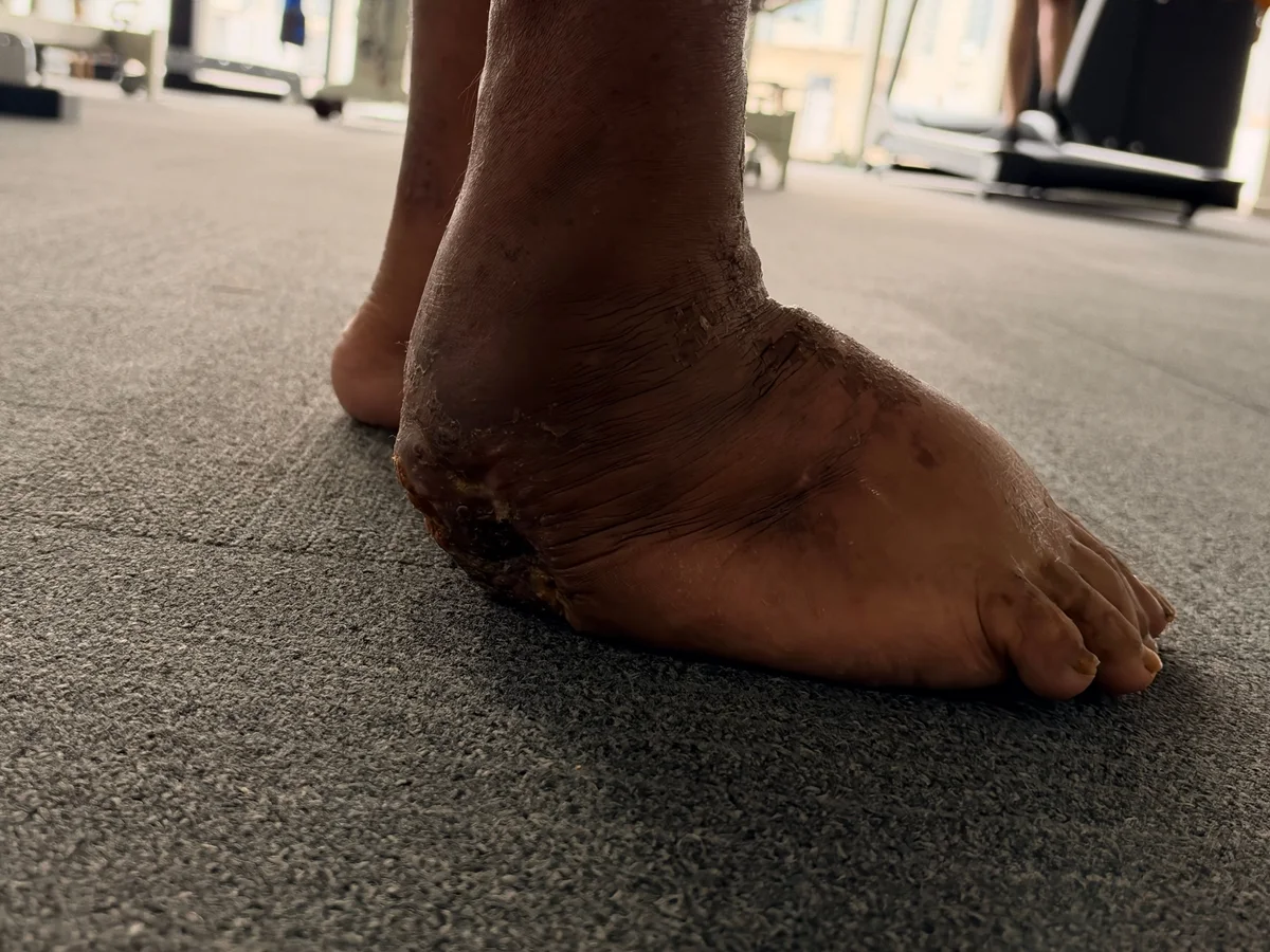 Side-view foot record photographed at DakshinRehab; loading permission requires individual assessment