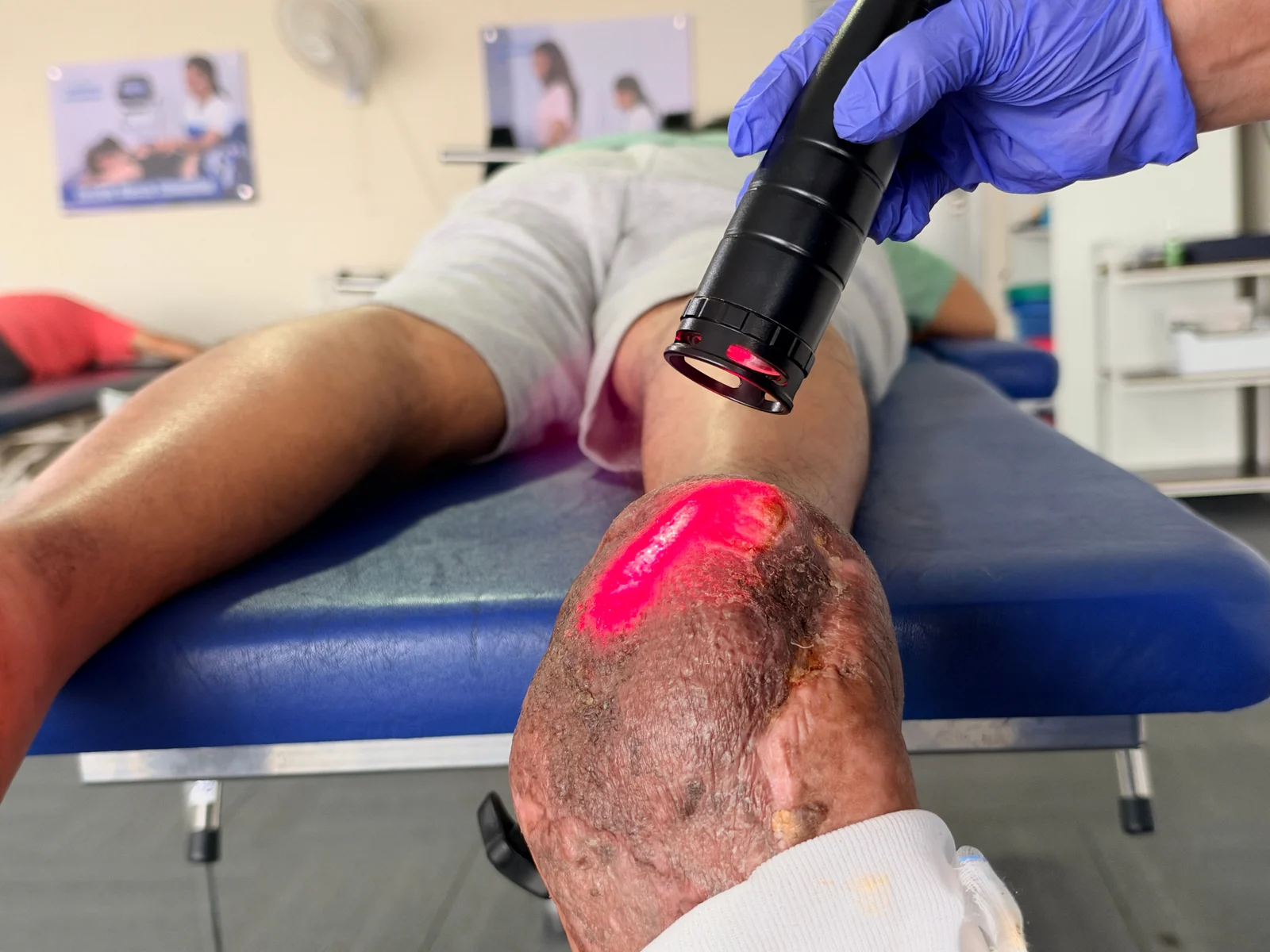 Class IV laser handpiece application around a foot at DakshinRehab